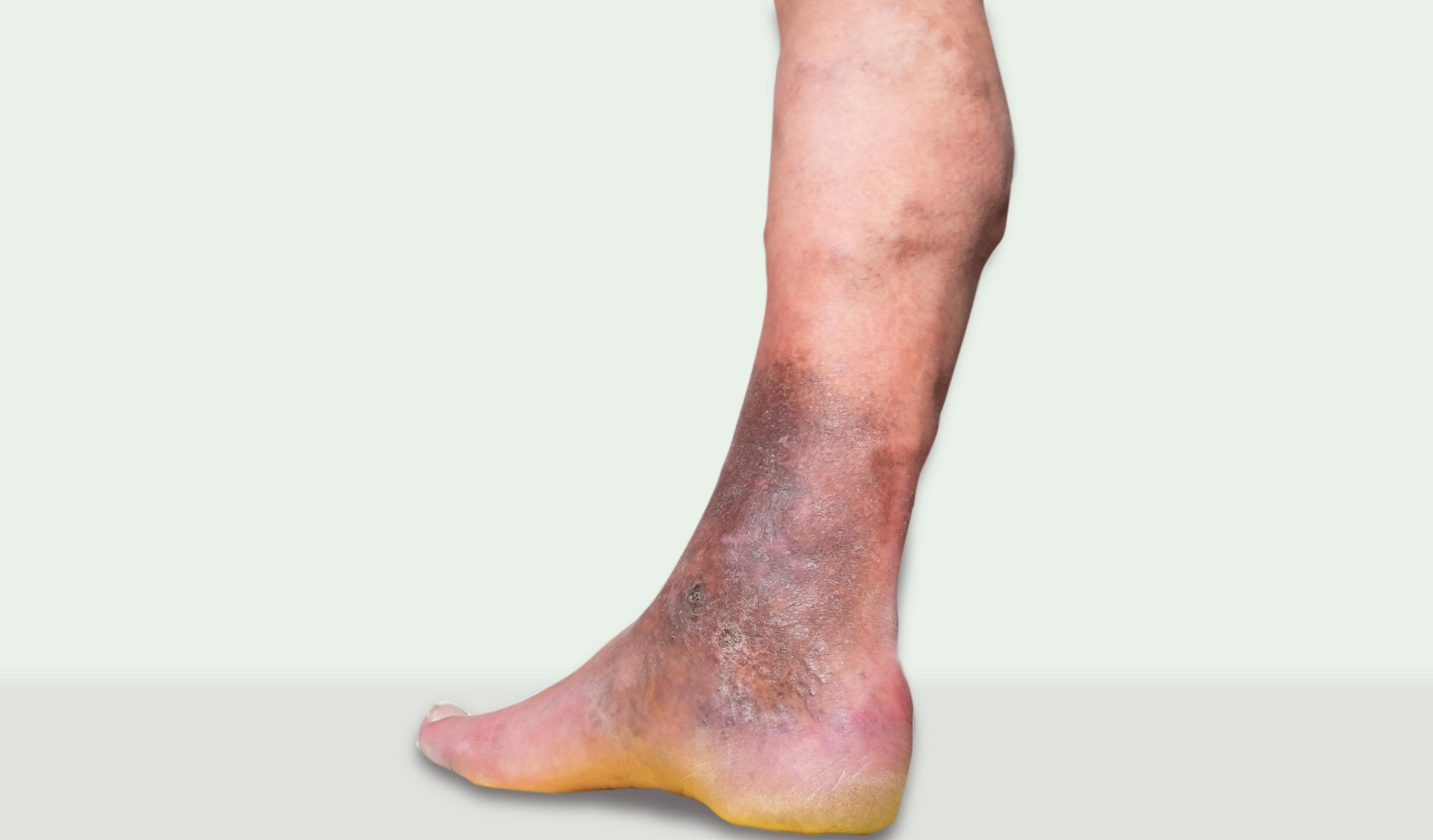 Leg with varicose eczema from foot to knee